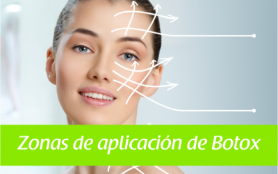 Zonas de Aplicación de Botox