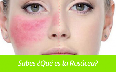 Sabes ¿Qué es la Rosácea